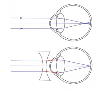 Un oeil myope, puis un oeil myope corrigé par une lentille divergente.