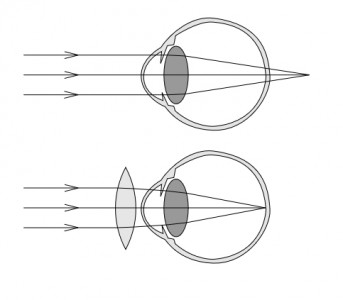 Un oeil hypermétrope, puis un oeil hypermétrope corrigé par une lentille convergente.